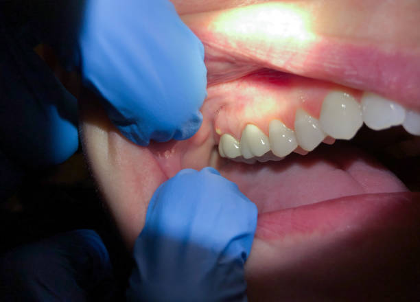Best Cracked Tooth Emergency Dentist  in Payne, OH